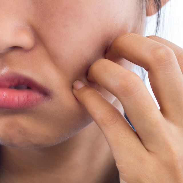 Person working toward healing from dermatillomania and compulsive skin picking